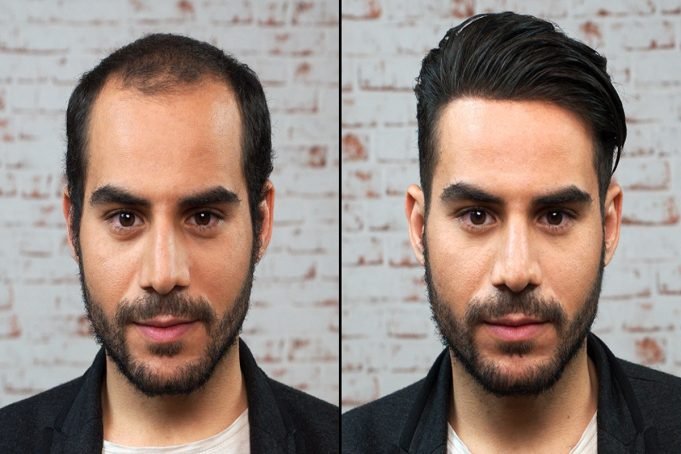 Best Hair Transplant Clinics in Turkey