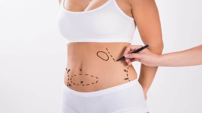 Liposuction in Turkey