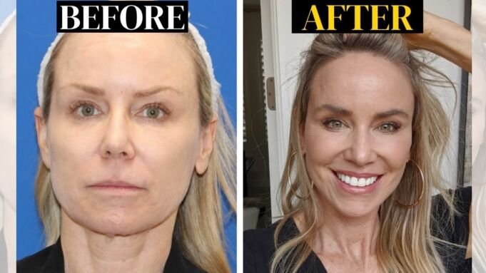 What is a Vertical Restore Facelift