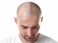 What to Do After Getting a Scalp Tattoo? Scalp Tattoo