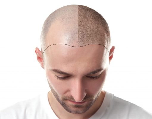 What to Do After Getting a Scalp Tattoo? Scalp Tattoo