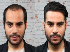 Top 3 Best Hair Transplant Clinics in Turkey – Everything You Should Know Best Hair Transplant Clinics in Turkey