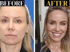 What is a Vertical Restore Facelift? What is a Vertical Restore Facelift