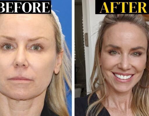 What is a Vertical Restore Facelift? What is a Vertical Restore Facelift